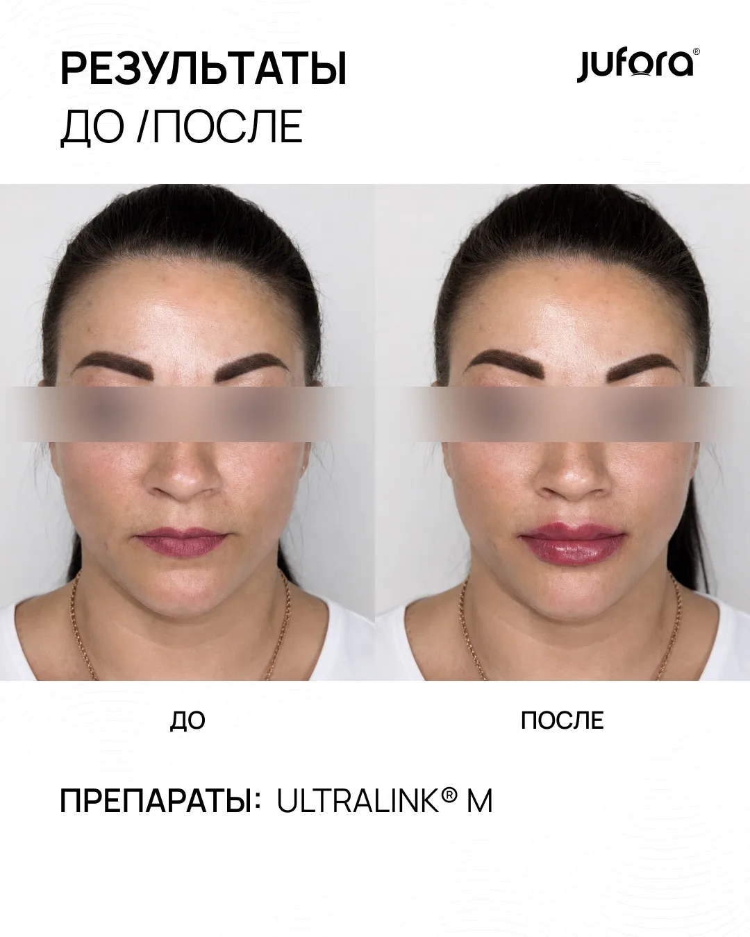 Сегодня в кадре: коррекция губ препаратом JUFORA ULTRALINK® M 👄
Монофазный филлер деликатно восполн