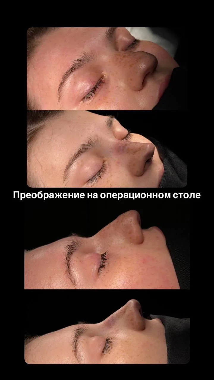 Ринопластика: гармония важнее размера