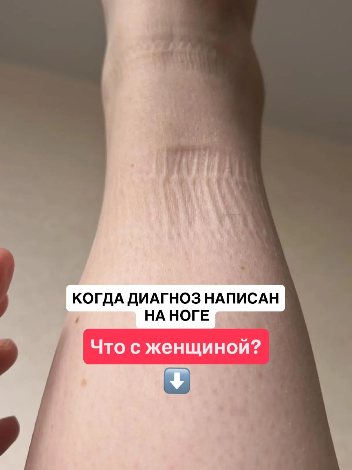 Надавили на голень. Ямки нет.