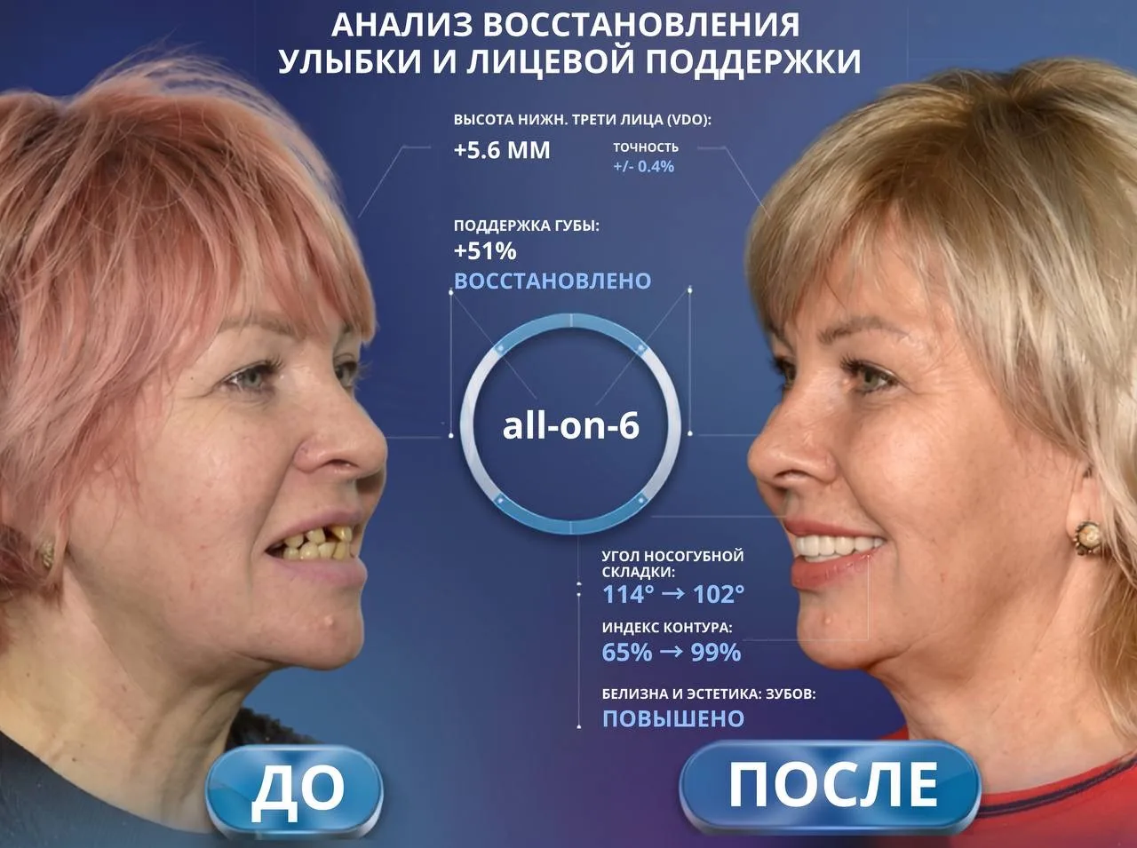 ❗️«Имплантация — это долго и наверняка больно». Так думают почти все, кто годами откладывает лечение