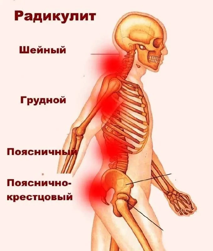 От радикулита.

Валерьянка на спирту с добавлением жгучего перца используется как согревающий компре