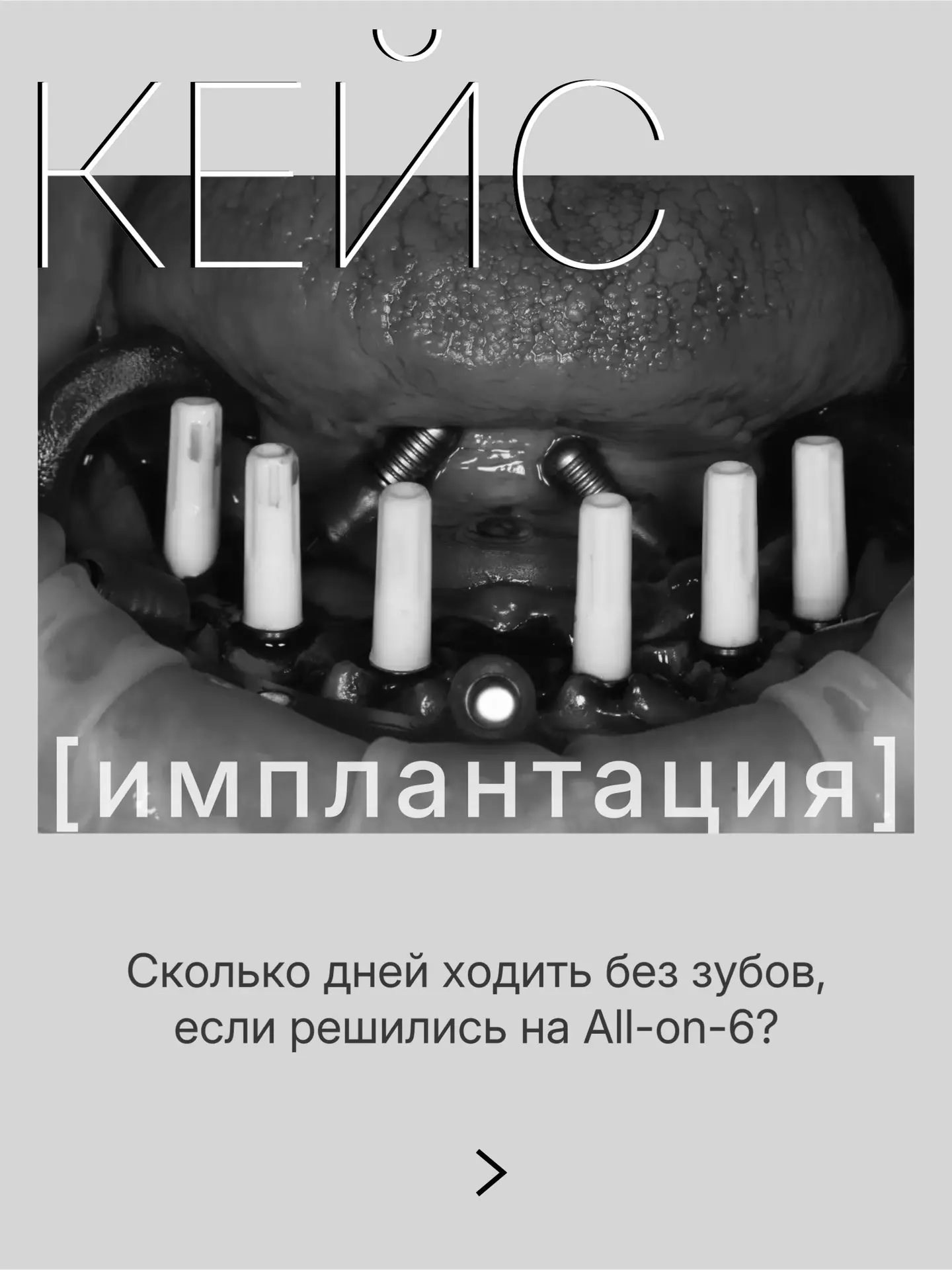 Сколько дней ходить без зубов, если решились на All-on-6?
