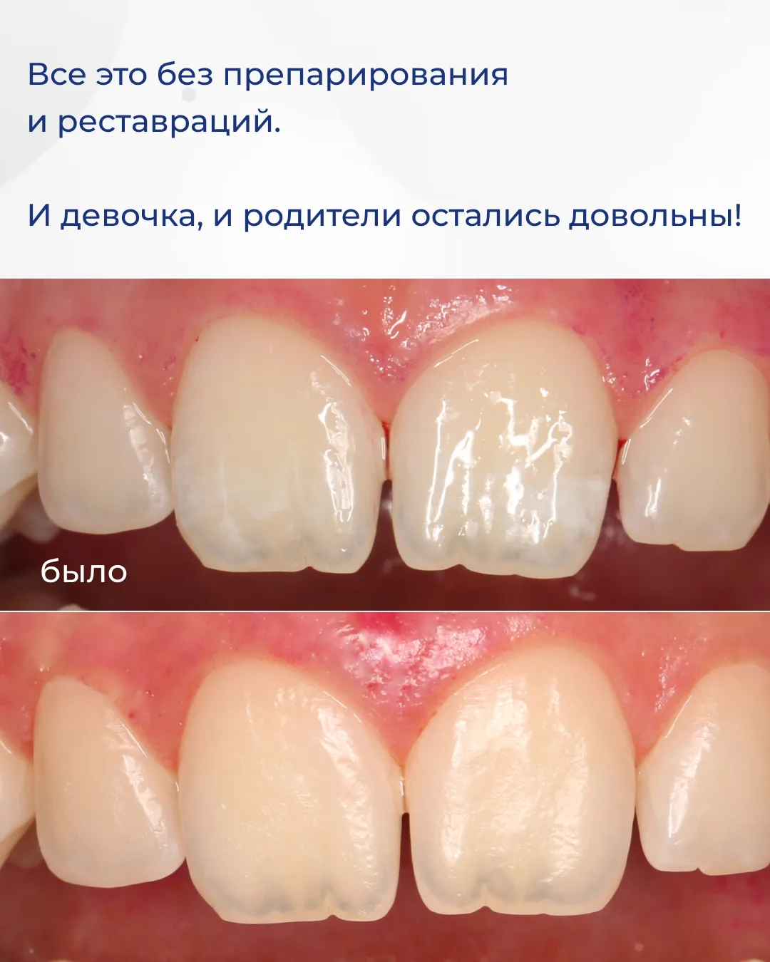 Устраняем дисколорит зубов за одну процедуру! Как это возможно? Сейчас расскажу! Пациентке 11 лет. Б