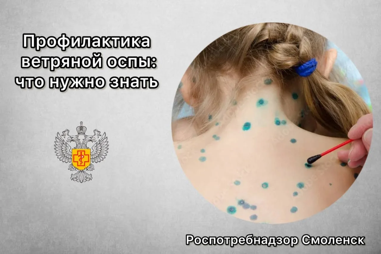 🦠 Профилактика ветряной оспы: что важно знать

Ветряная оспа (ветрянка) – острое инфекционное забол