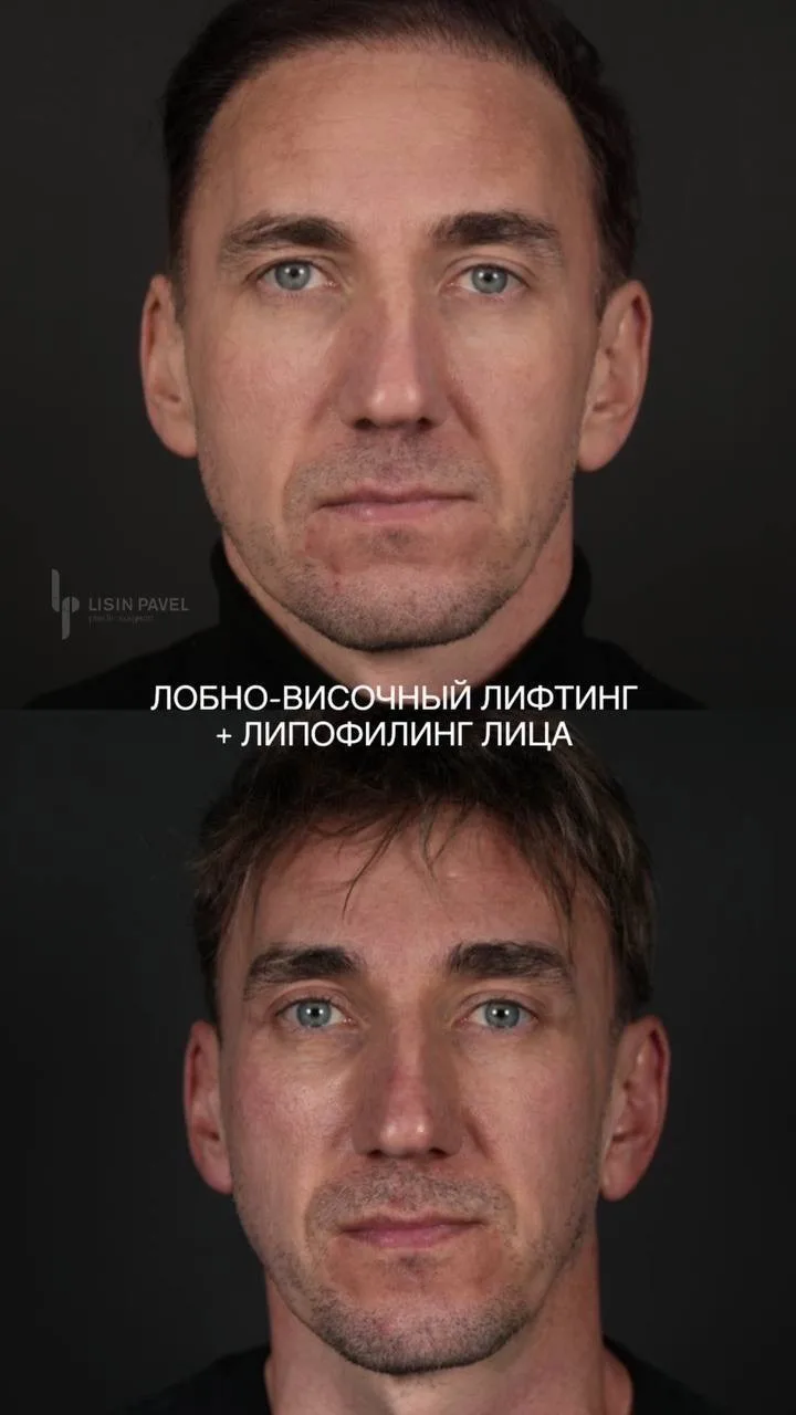 Мужской лобно-височный лифтинг.