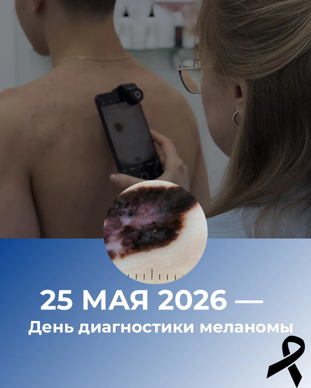 25 мая — День диагностики меланомы 🖤