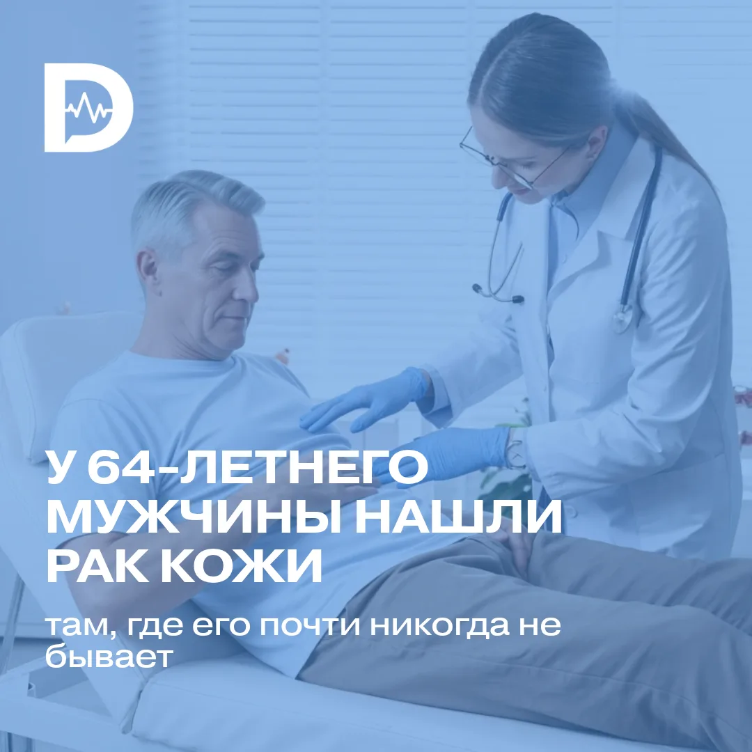 Меланома, или рак кожи, считается одним из самых агрессивных онкозаболеваний. И обычно ...