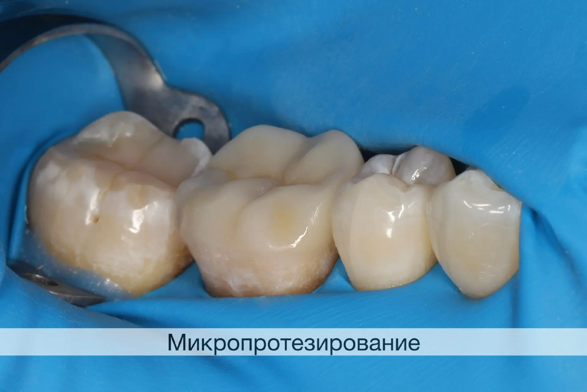 Керамическая вкладка E-max.
Адгезивная фиксация на цемент двойного отверждения NX3, Kerr.

Готовлю з