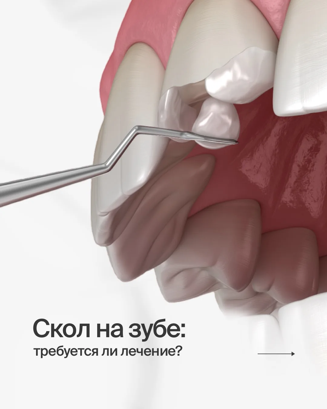 📌 СКОЛ НА ЗУБЕ: ТРЕБУЕТСЯ ЛИ ЛЕЧЕНИЕ?