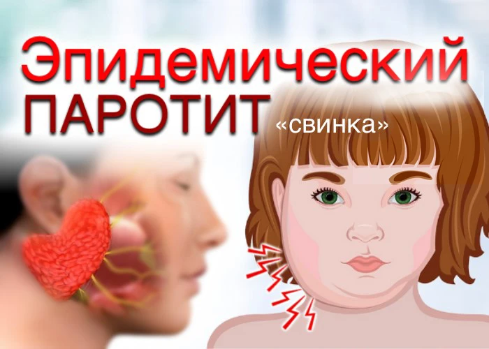Свинка (паротит) — это вирусная инфекция, которая бьет по слюнным железам и опасна осло...