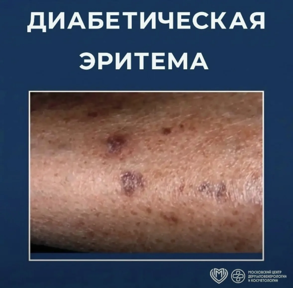 💉Диабетическая эритема – наиболее часто встречающиеся кожное проявление при сахарном д...