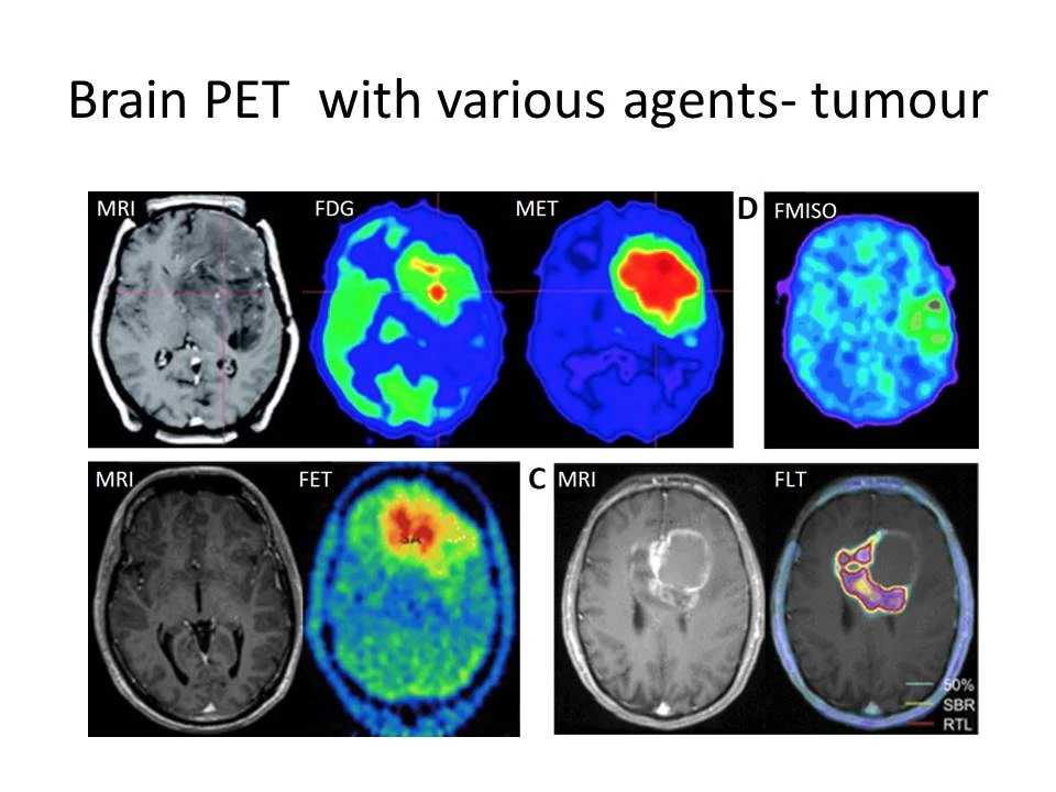 🧠 Глиома: новые способы диагностики и лечения

Междисциплинарный консорциум специалистов Института 