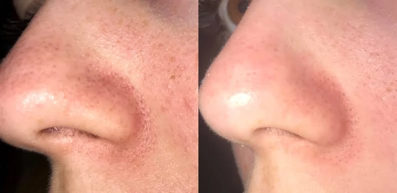 👃 Черные точки на носу не уходят? Возможно, это сальные нити, которые вы чистите непра...