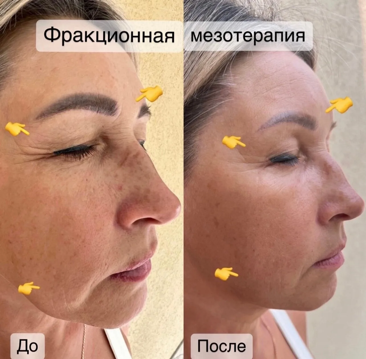 Аппаратная мезотерапия.🌟🌟🌟 Омоложение, осветление пигментации, лечение угревой сыпи,...