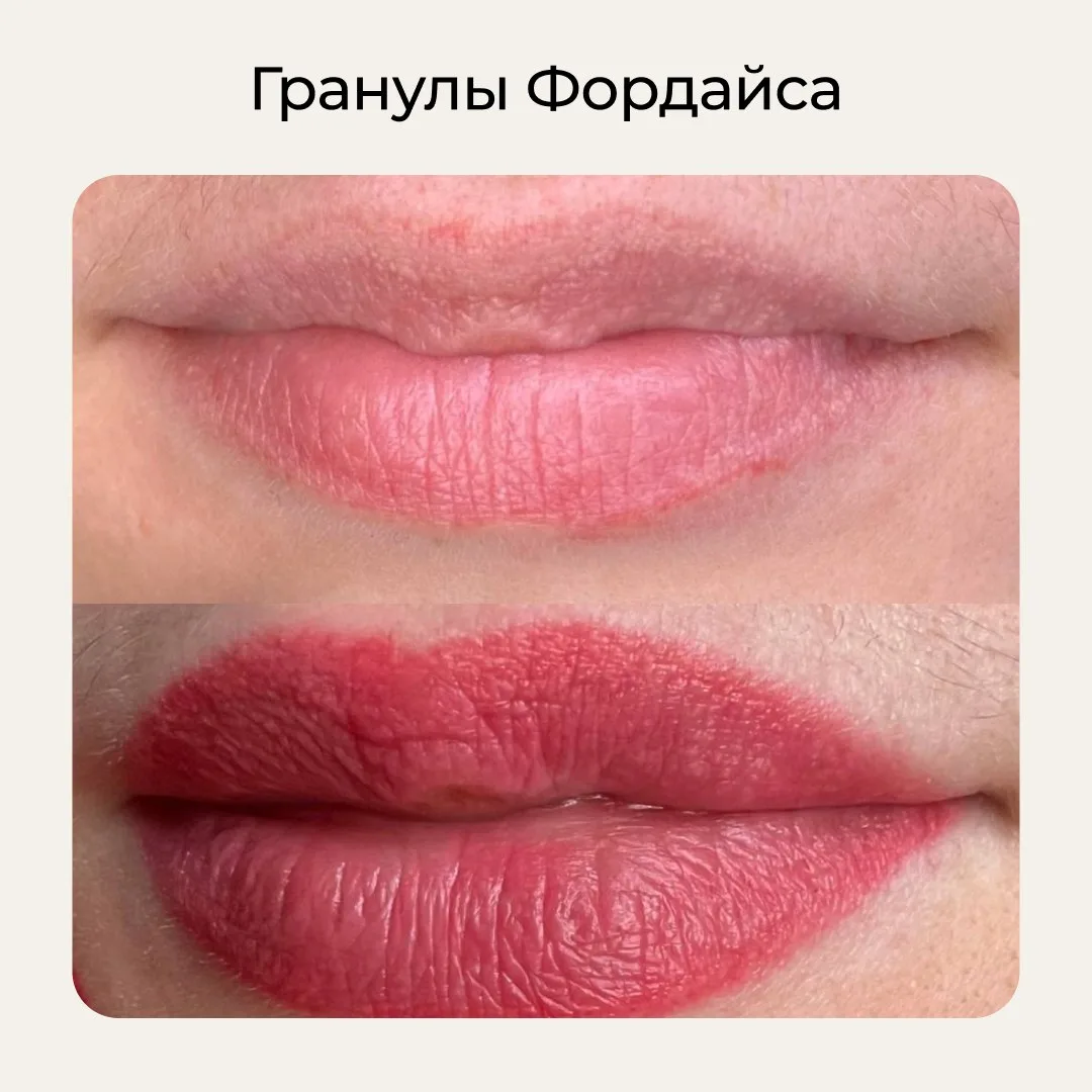 🤍 Знаете, что это за маленькие светлые точки на губах сверху?