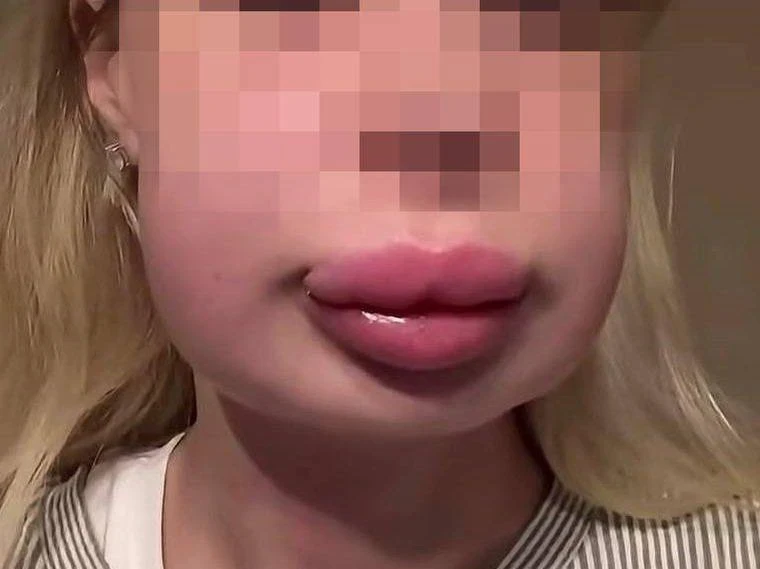 😱 Москвичка столкнулась с отёком Квинке после удаления филлера