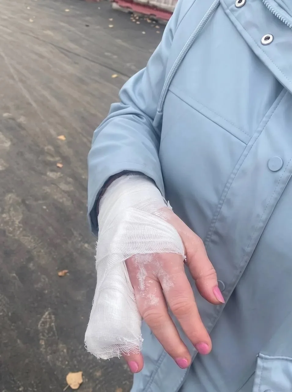 Женщина сломала руку из-за торчащего прута в новом асфальте Зеленограда.