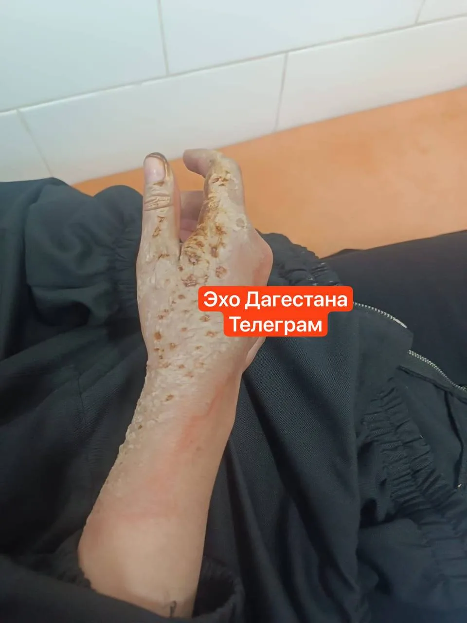 ⚡️😱 12-летнего ребенка ударило током высоковольтными проводами в Курахском районе в селе Хпюк 

У р
