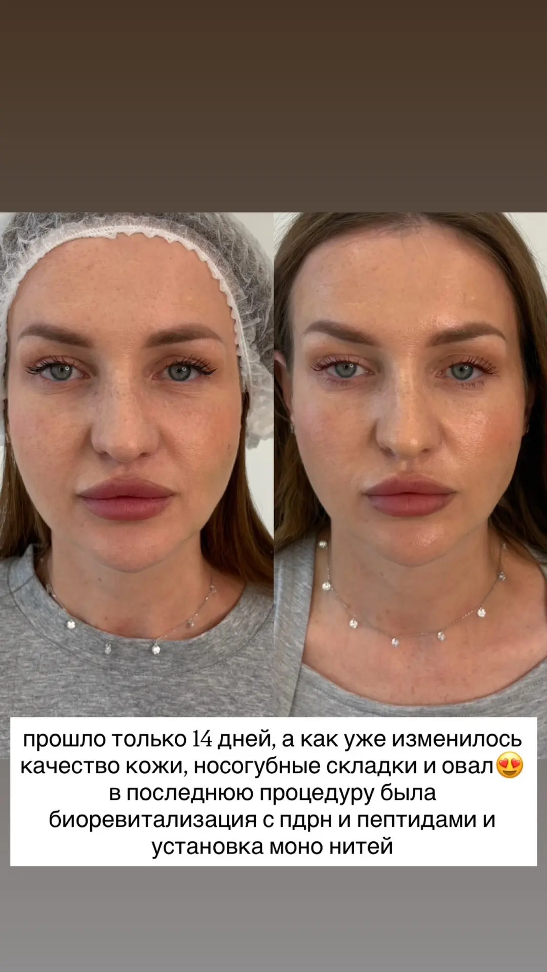 Гравитация, увы, работает без выходных, и со временем контуры лица начинают «плыть».