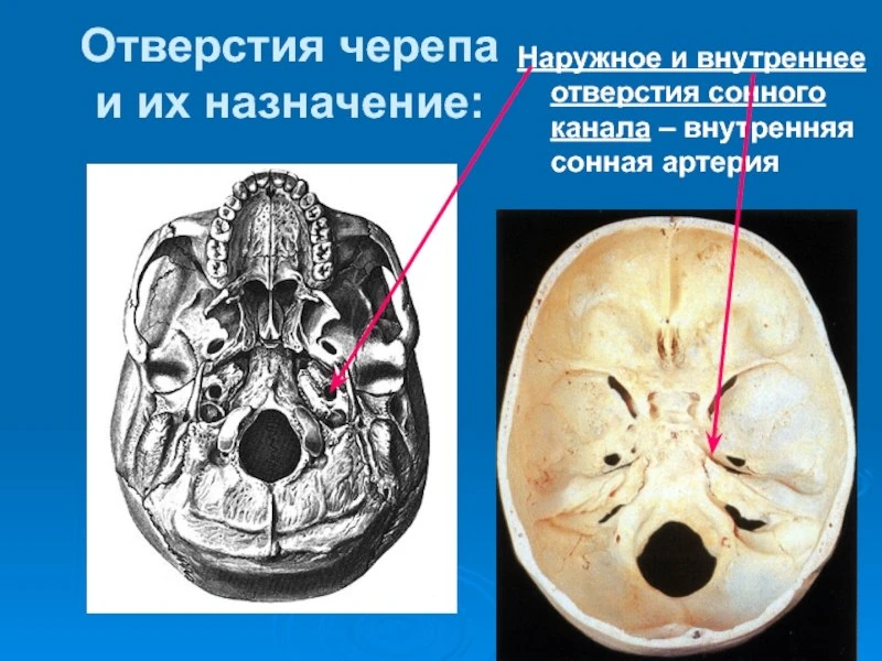 Сонный канал (canalis caroticus) начинается в средних отделах нижней поверхности камени...