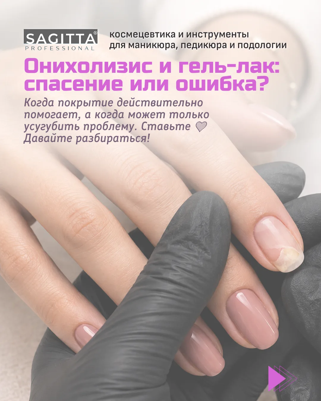 ОНИХОЛИЗИС всегда вызывает тревогу: клиент хочет «спасти красоту», мастер — не навредить.