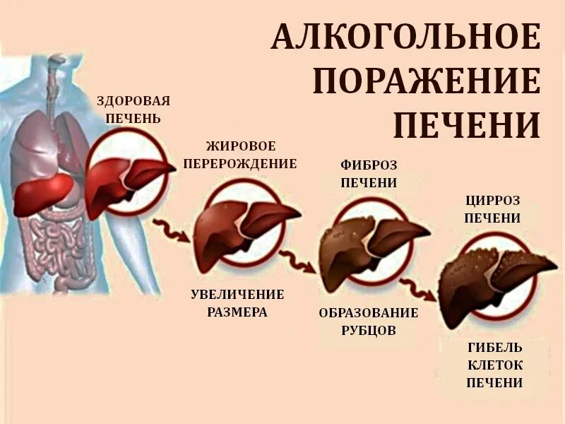 Алкоголь и печень: как спиртное разрушает главный фильтр организма