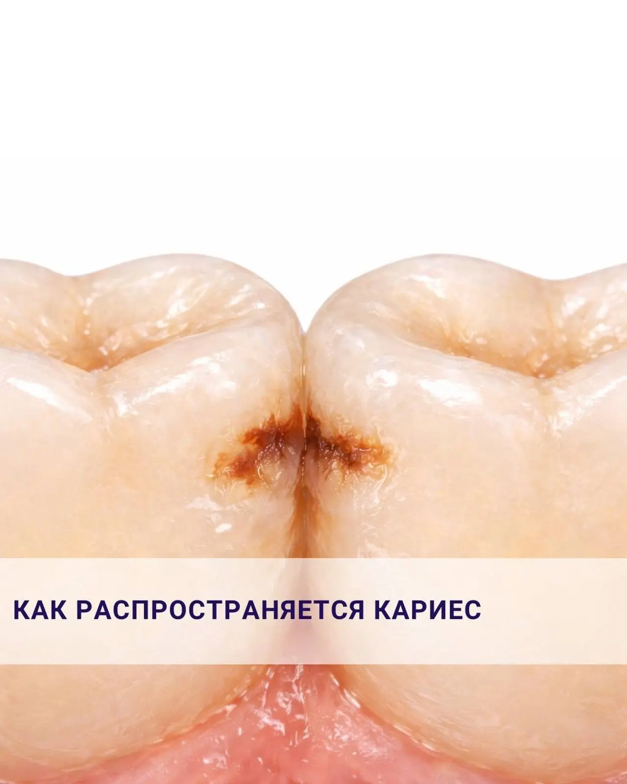Кариес связан с деятельностью бактерий в зубном налёте. И если условия для его развития...