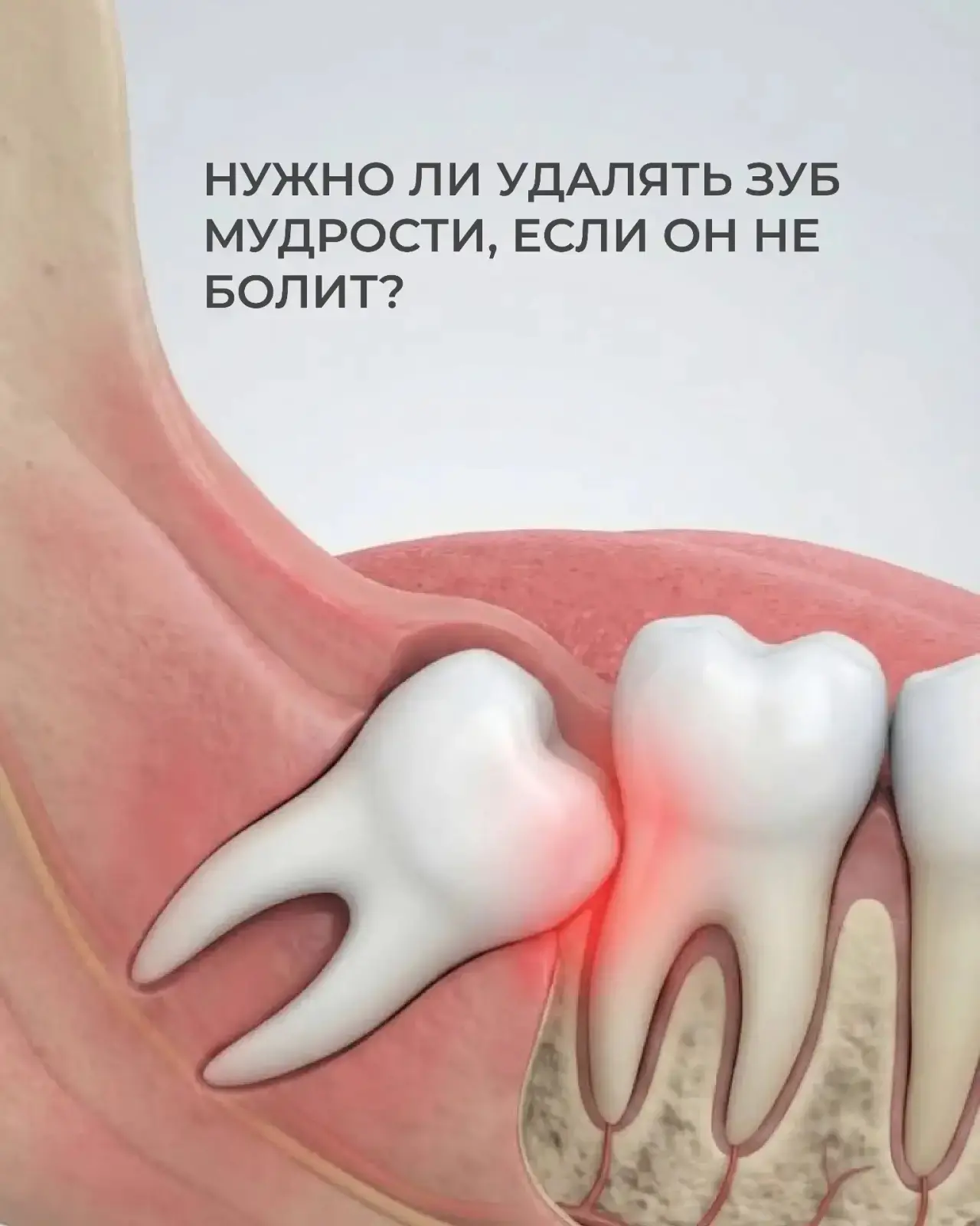 Зуб мудрости не болит — значит, удалять его не нужно? Не всегда.