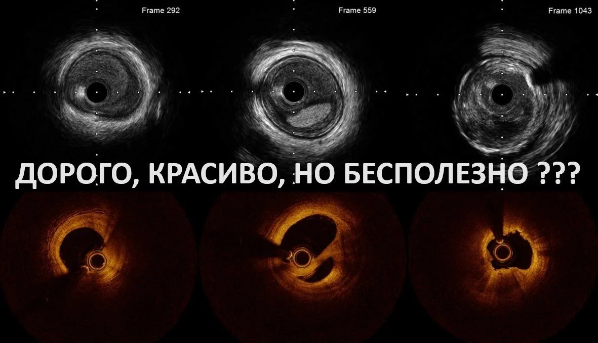ЧКВ под контролем ВСУЗИ не показало значительного преимущества перед вмешательствами бе...