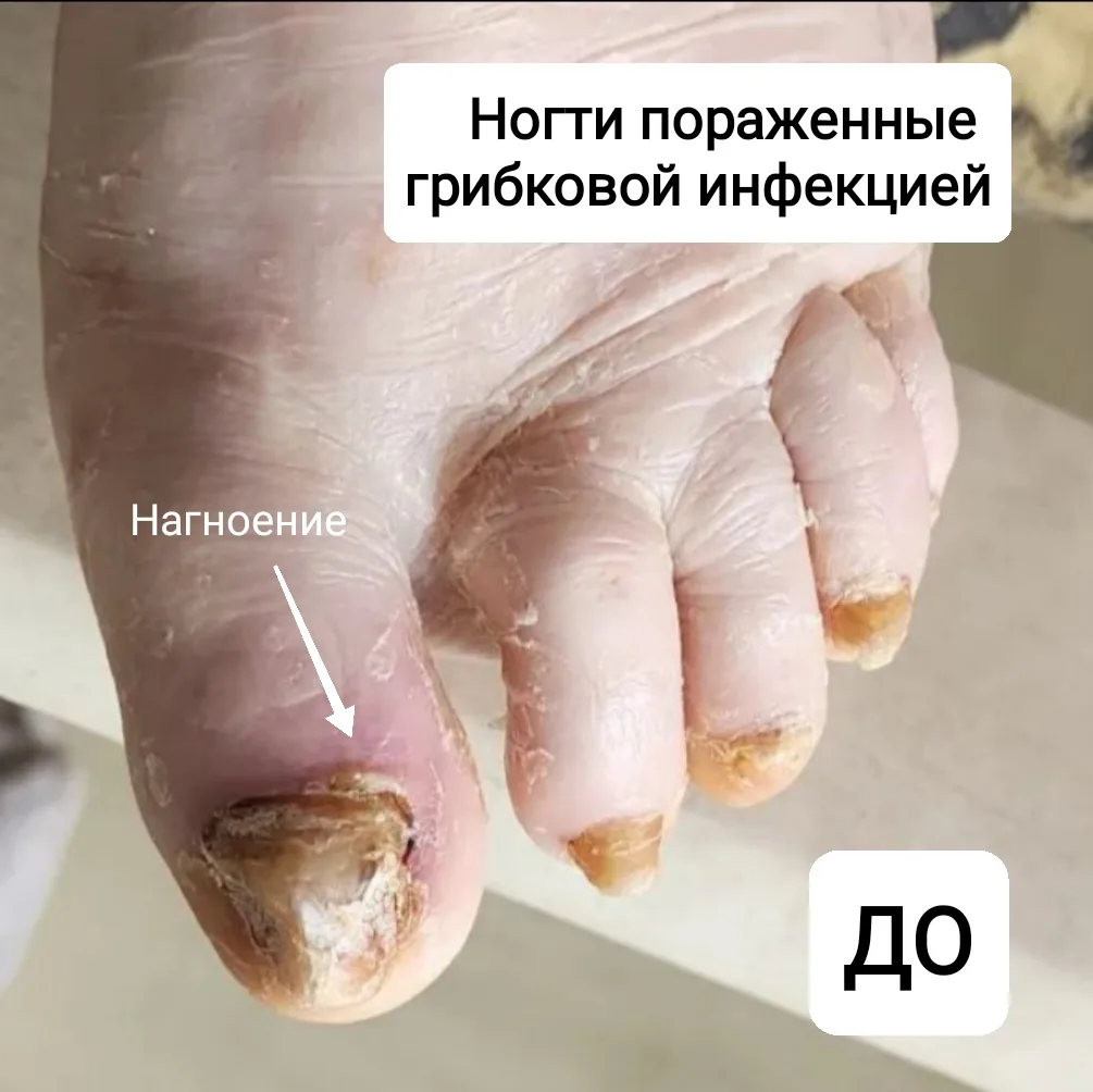 ☝️ Грибок разрушает ноготь постепенно.