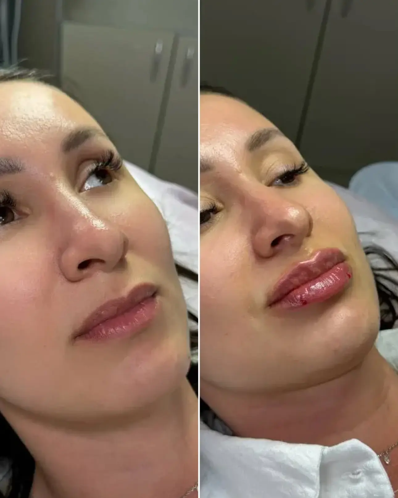 👄 Губы, которые не хочется скрывать. Губы, которые хочется показывать.

Контурная пластика — это не