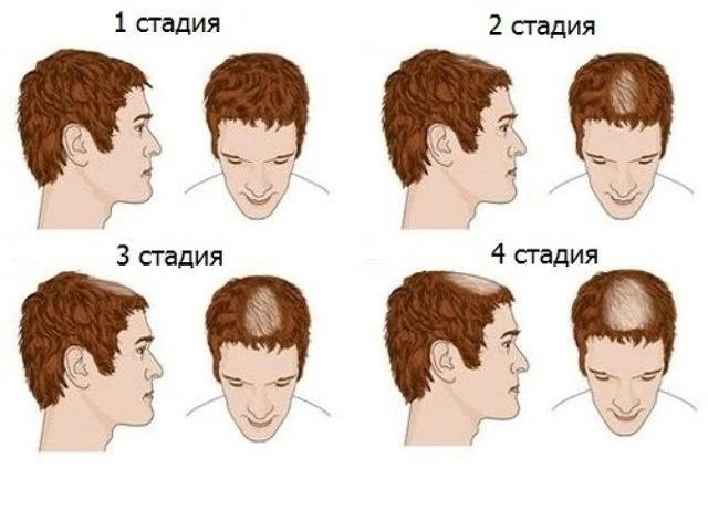 Андрогенная алопеция: почему волосы «уходят» и как их вернуть? 🧔‍♂️💨