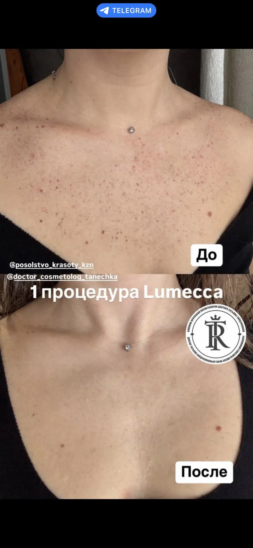 ✨ Кожа с ровным тоном без пигментных пятен – это реально! ✨