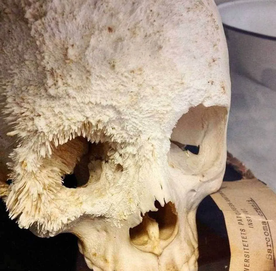 💀 Остеосаркома - злокачественная опухоль из незрелых клеток остеобластов. Характеризуе...