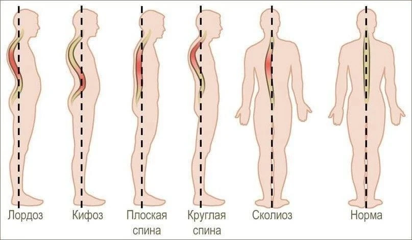 Корректируем осанку и избавляемся от болей в пояснице