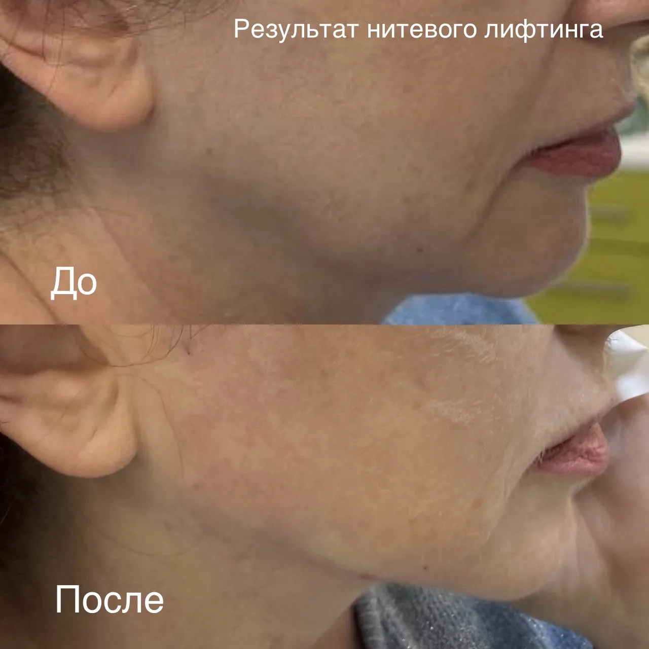 Результат нитевого лифтинга ✅

Нитевой лифтинг — это золотая середина между уколами красоты и пласти