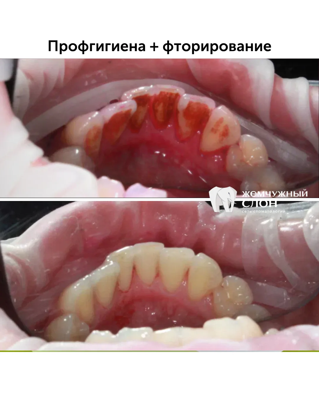 Профессиональная гигиена — это целый комплекс этапов. Сначала с помощью ультразвука уда...