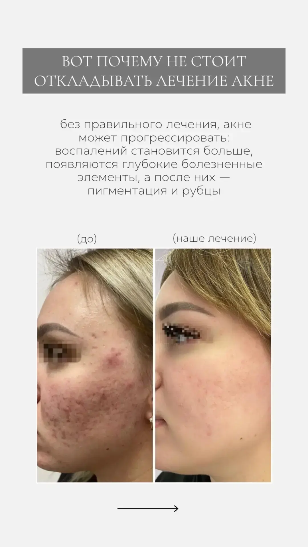 Почему акне нельзя оставлять без внимания? 🍀