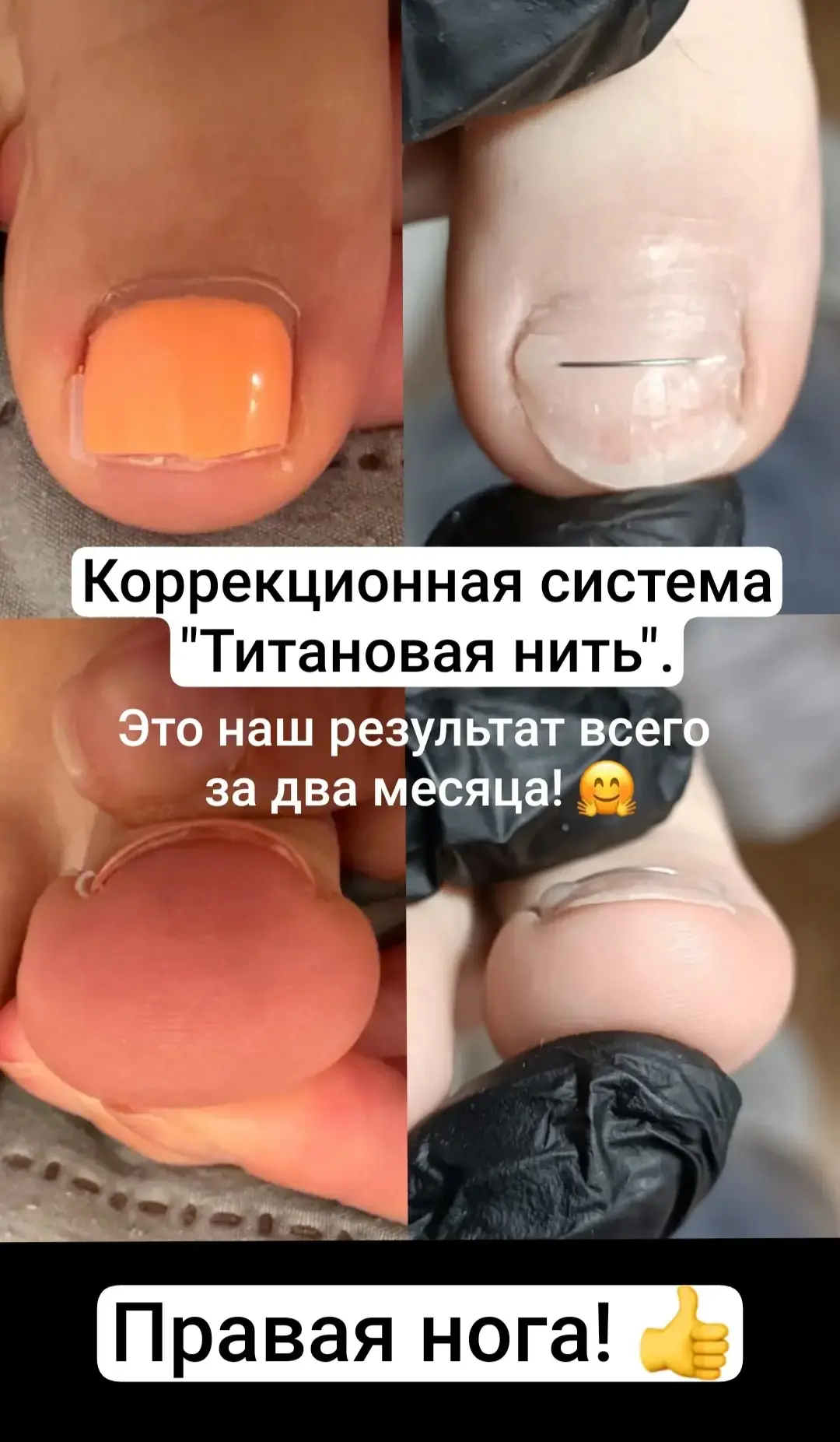Титановая нить - это тонкая корректирующая система, которая фиксируется на ногтевой пла...