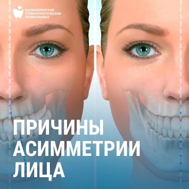 Причины асимметрии лица 🦷