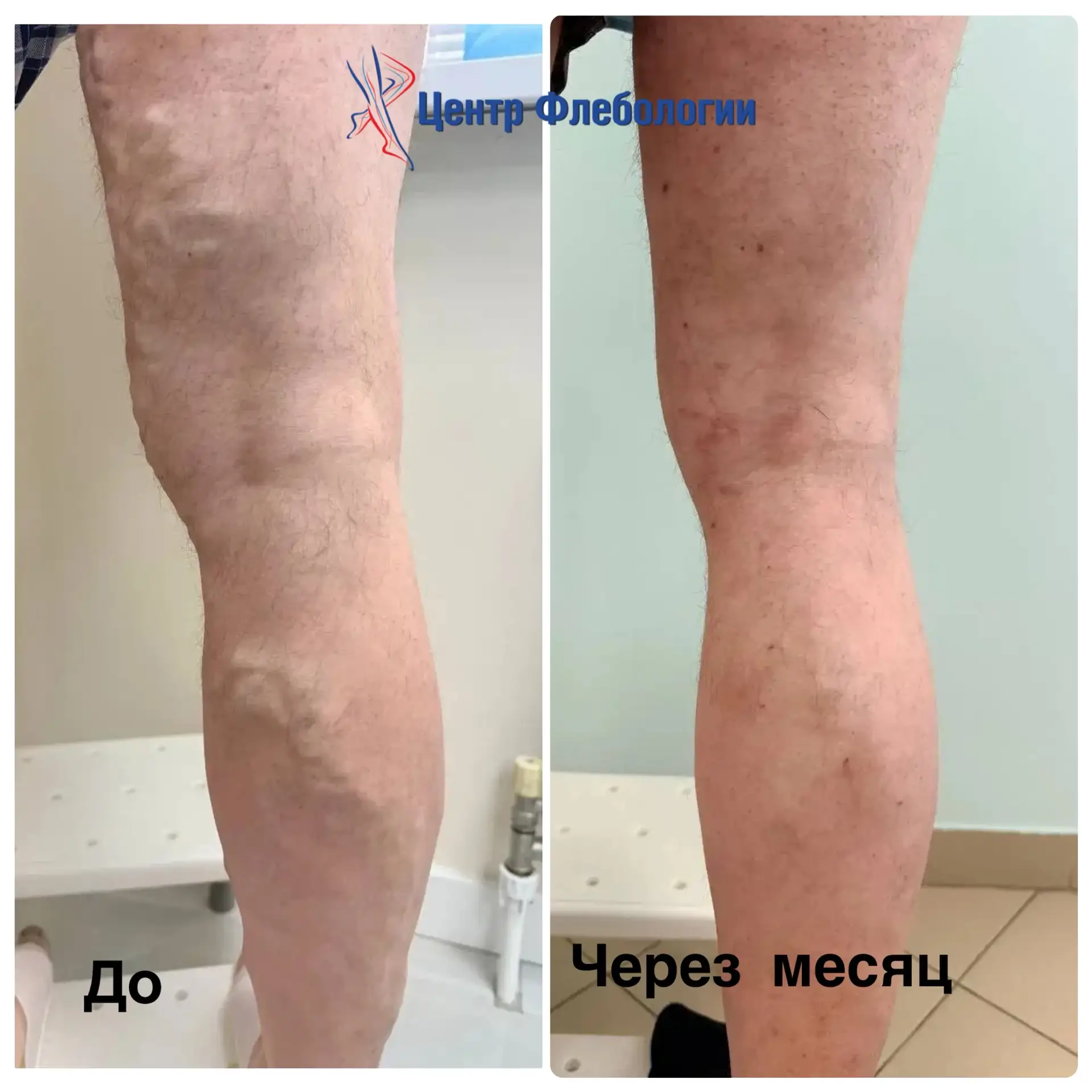 ⛔️Многие откладывают лечение варикоза на осень - зиму, боясь длительного ношения компре...
