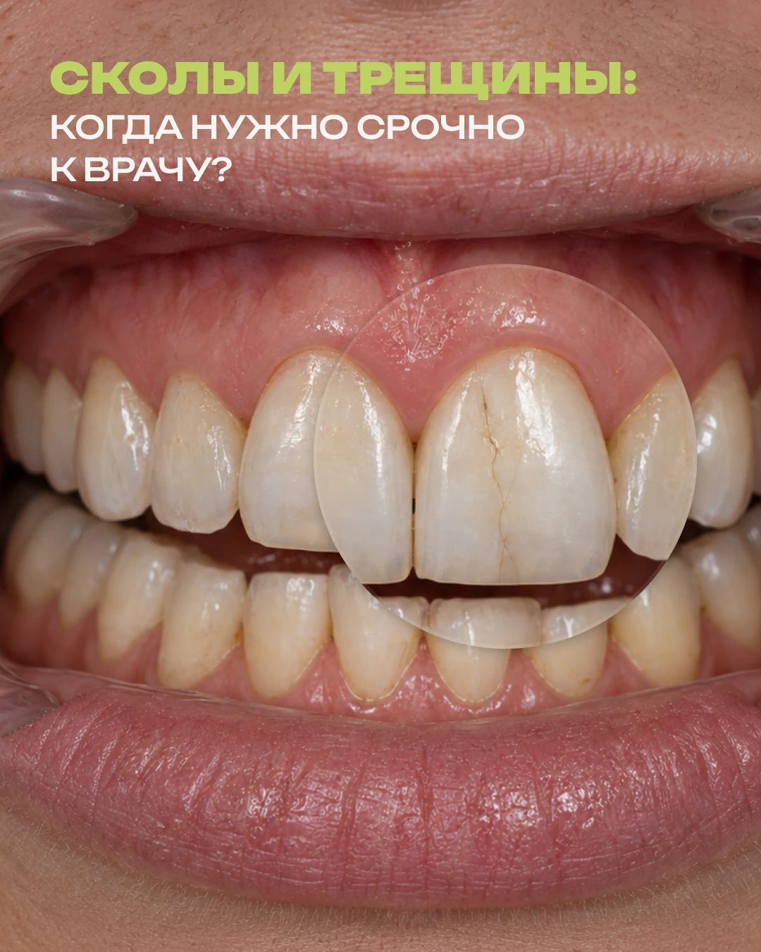 Сколы и трещины зубов — частая проблема, возникающая при откусывании твердой пищи, паде...