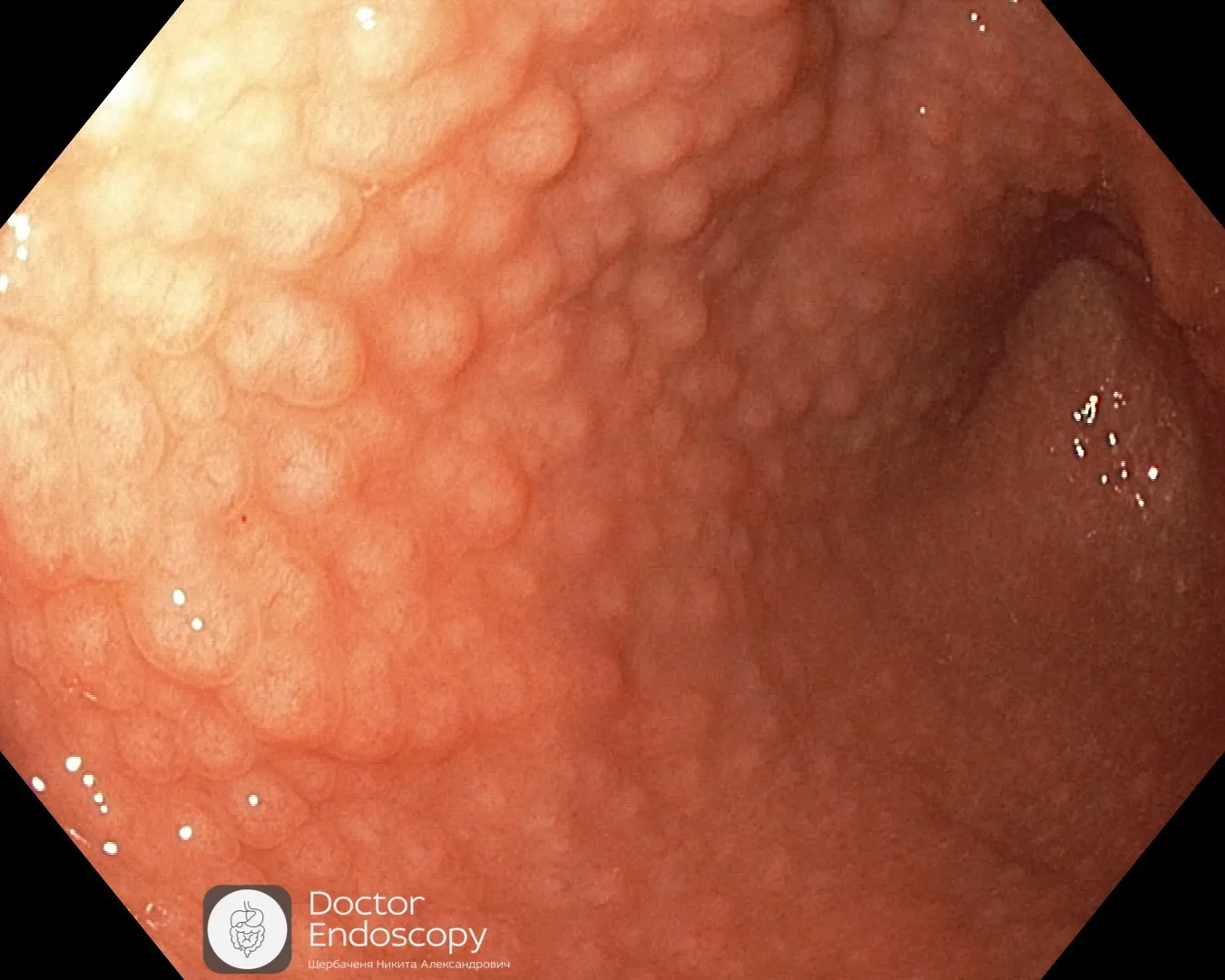 ✅🚫🦠 Не Helicobacter pylori Helicobacter-ассоциированный гастрит. Часть 2.

✅ Сообщалось о признаке