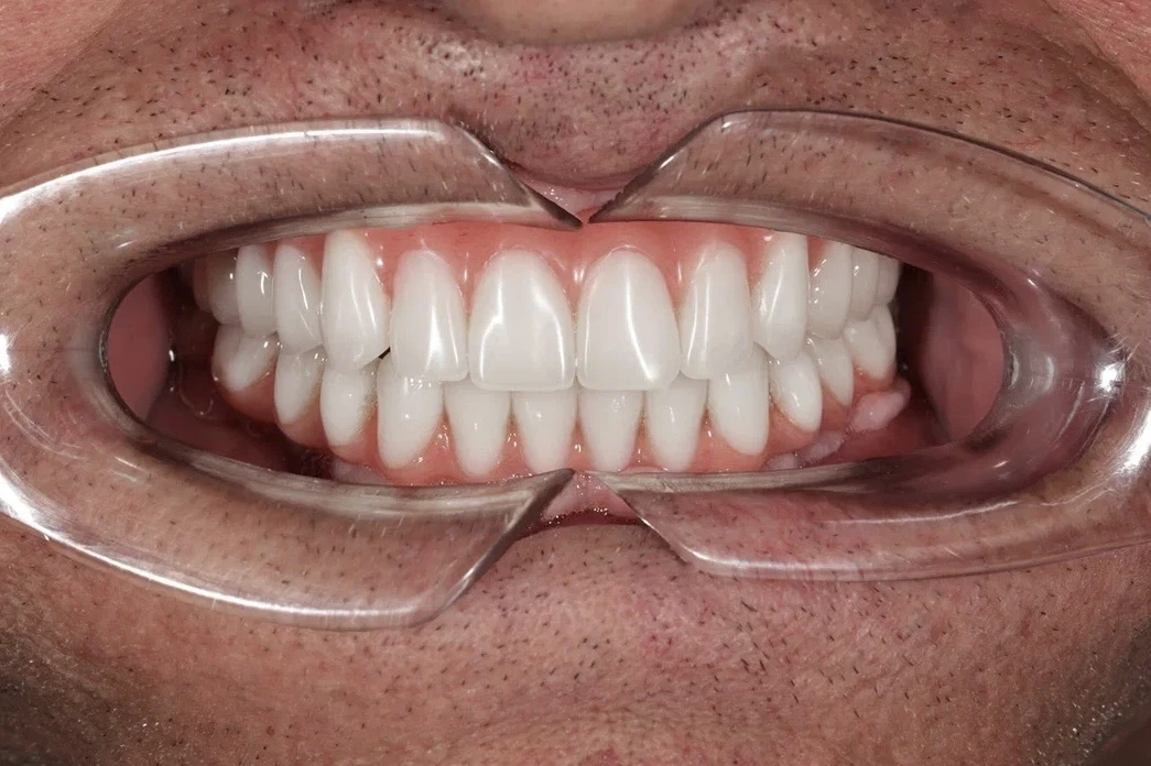 🦷 ДО/ПОСЛЕ. Восстановили все зубы сразу за 3 дня!   Пациент обратился в клинику с критическим состоя