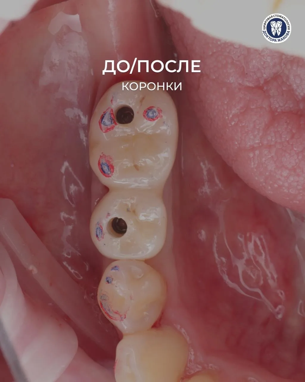 🦷 История, которая начиналась с удаления, а закончилась новой улыбкой