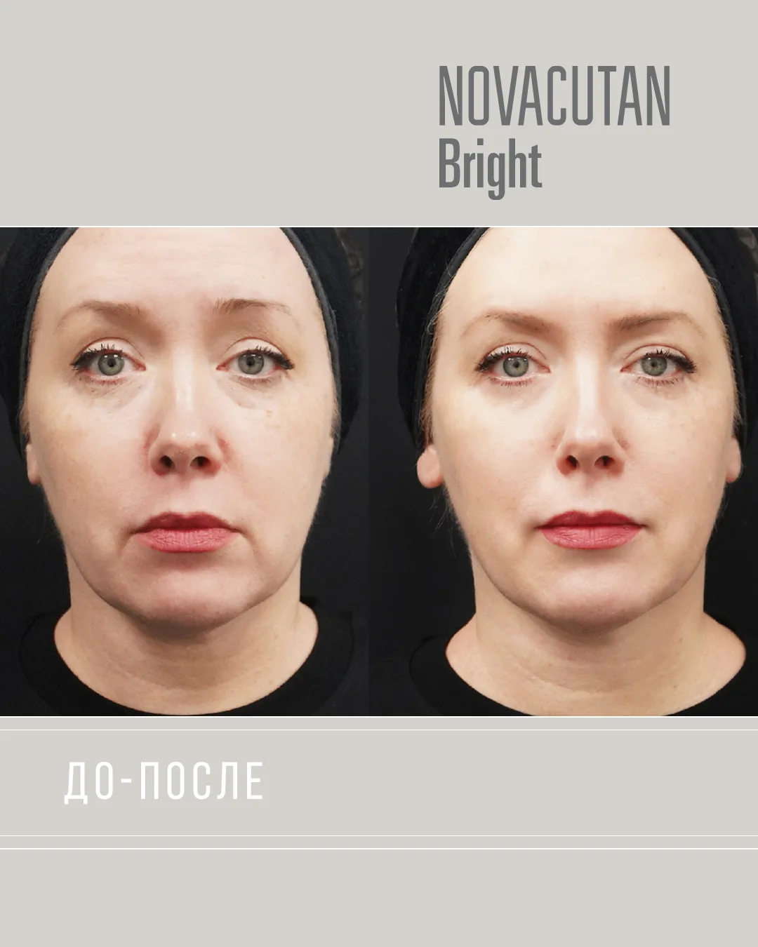 ДО/ПОСЛЕ 

Novacutan Bright

Фотоповреждённая кожа

Ольга, 48 лет год

Показания: Активное фотоповре