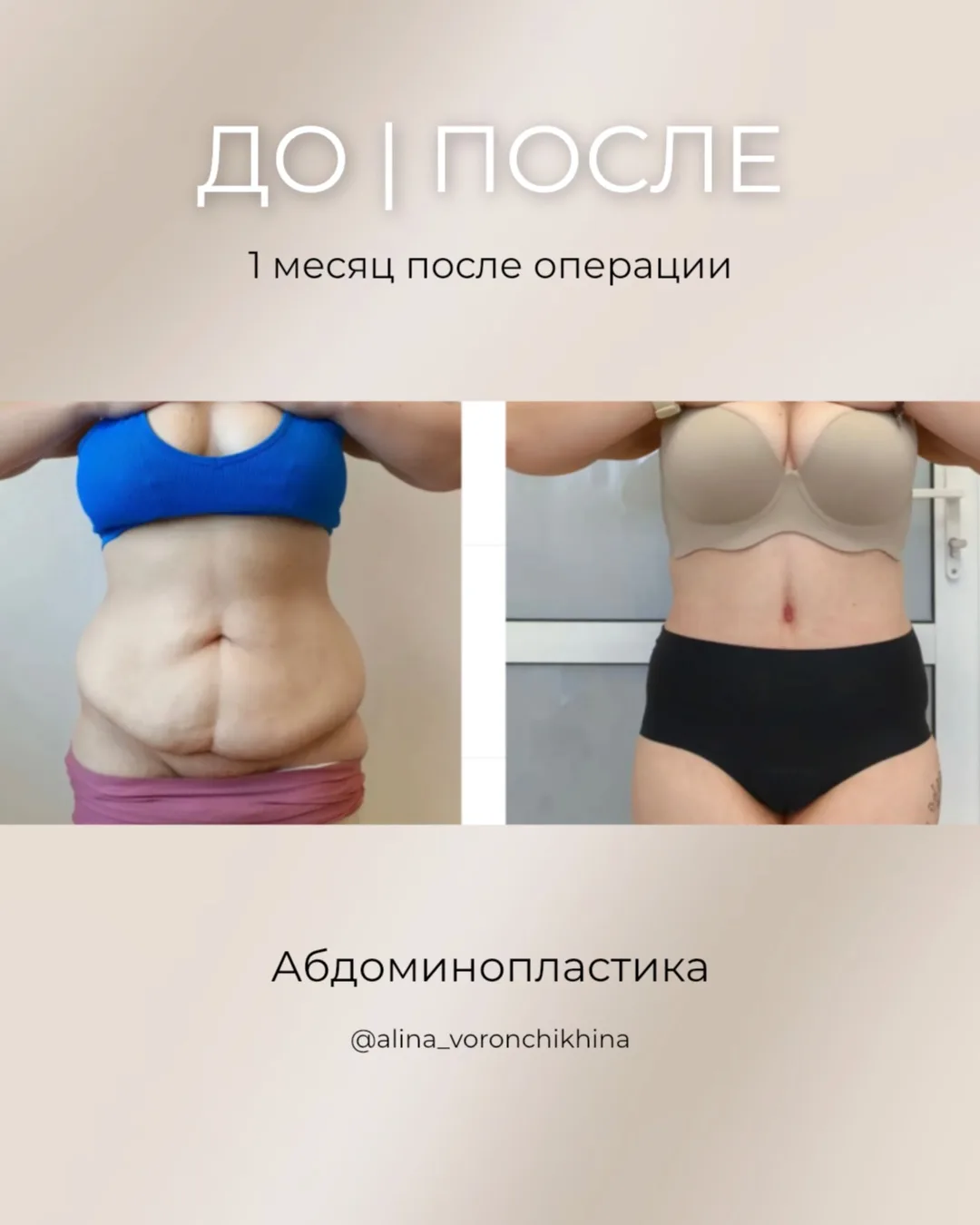 Спустя 1 месяц после абдоминопластики 😍