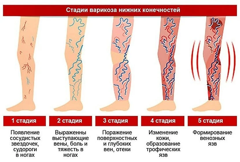 ➡️Варикозное расширение вен: что нужно знать

С целью увеличения ожидаемой продолжительности жизни з