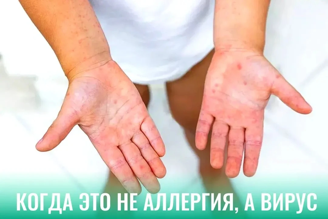 Лето, жара и невидимая угроза: как защитить ребёнка от энтеровируса

С наступлением тепла в детских 