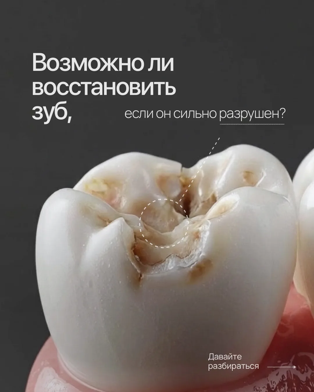 Мы за то, что сохранить максимально зуб 🦷